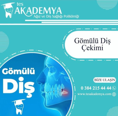 Türkiye Gömülü Diş Çekimi Tedavisi. Gömülü Diş Nedir?