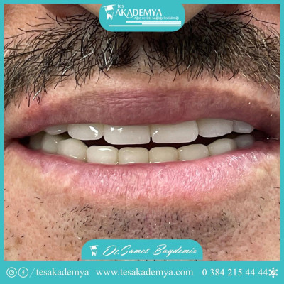 The image of our patient before and after treatment #hospital #dental #treatment #Contemporary #treatmentmethods  #TeethWhitening #Implant #Surgical #Tooth #Extraction #AestheticFilling #Zirconium #Coating #Orthodontics