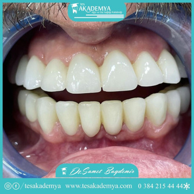 The image of our patient before and after treatment #dental #treatment #Contemporary #treatmentmethods  #TeethWhitening #Implant #Surgical #Tooth #Extraction #AestheticFilling #Zirconium #Coating #Orthodontics #successfully #applied  #Oral #Heal
