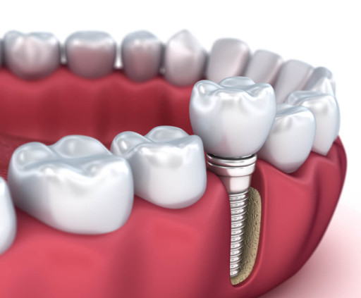 Cappadocia Implant Dental Treatment