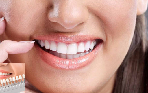 Turkey Zirconium Dental Veneers - Daily Examination
