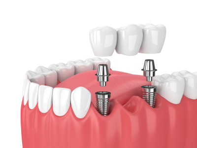 dental implant treatment in turkey diş tedavisi.jp