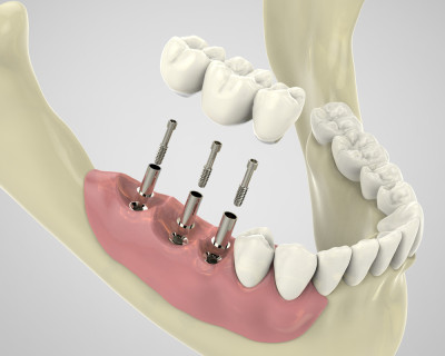 kapadokya nevşehir implant diş tedavisi