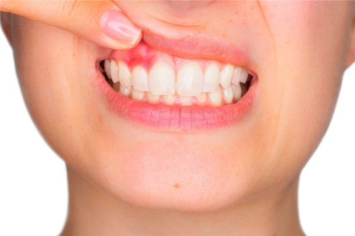 Kapadokya Diş Eti Hastalıkları Tedavisi - Periodontoloji