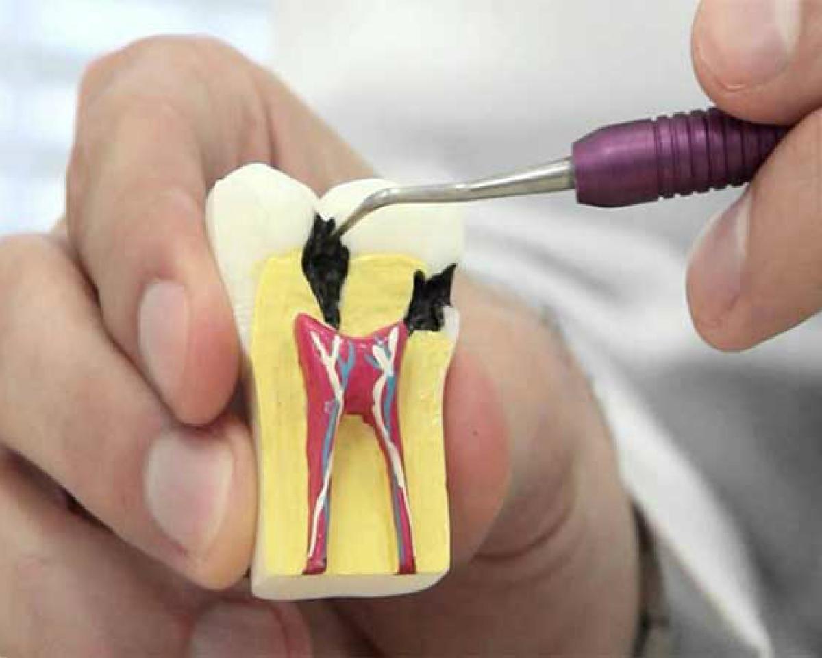 Kapadokya Kanal Tedavisi - Endodonti 2Gün