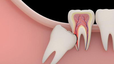 20-lik-dis-cekimi 20 years old teeth turkey